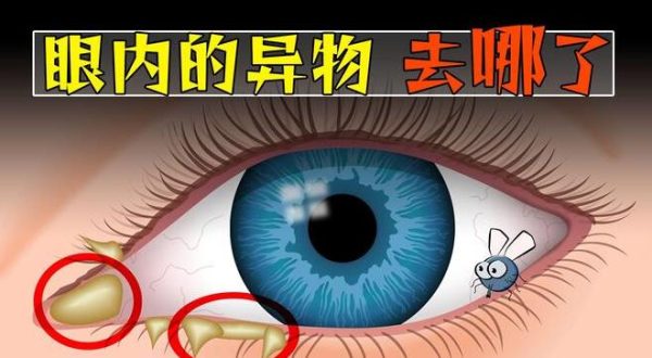 飞进眼睛的异物，消失去哪了？ - 壹悠家